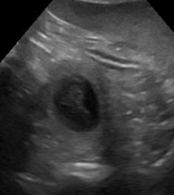 Ultraschall